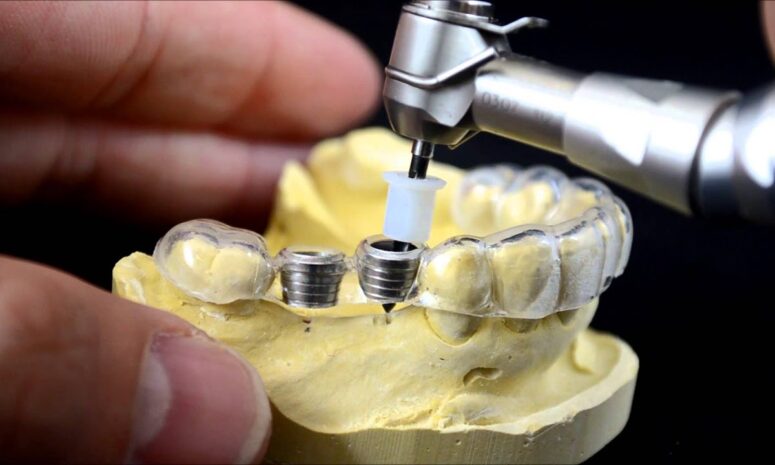 How Surgical Guide Can Help Your Teeth Problems